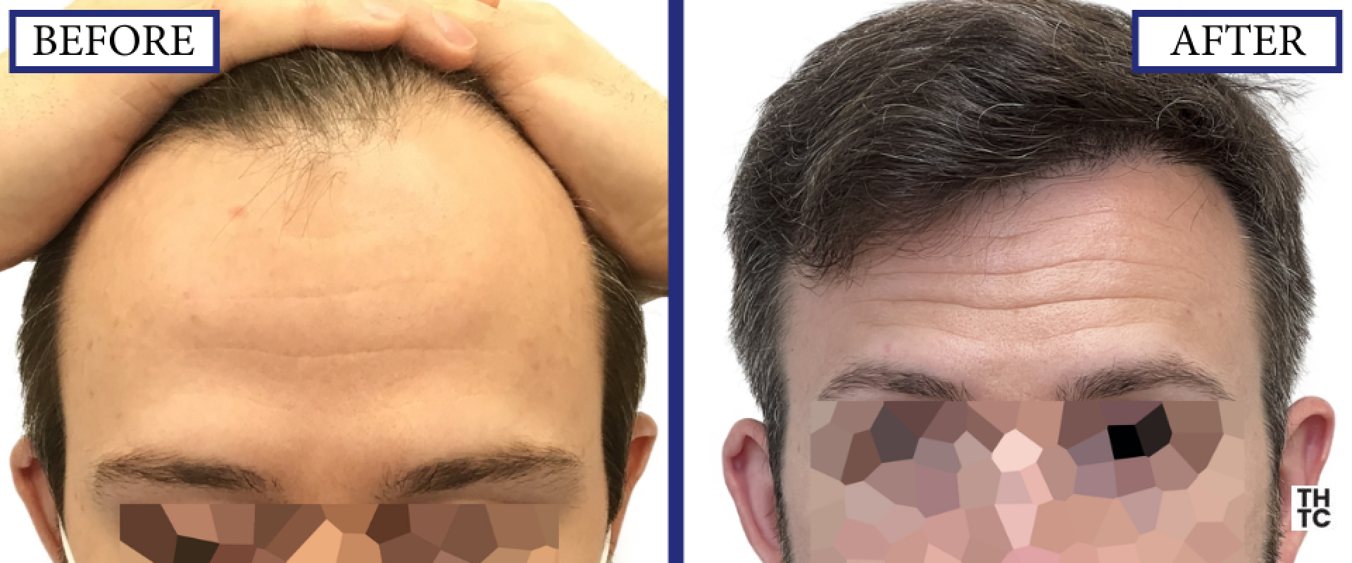 Hair Transplant Toronto